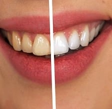 Zahnbleaching