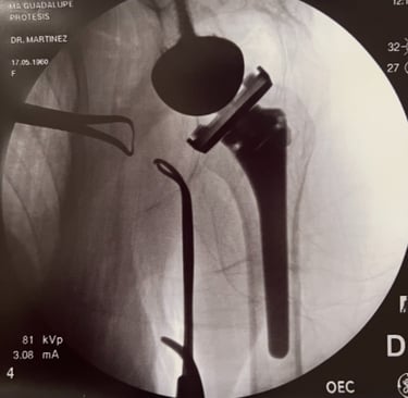 Control de radiografía de prótesis reversa de hombro.