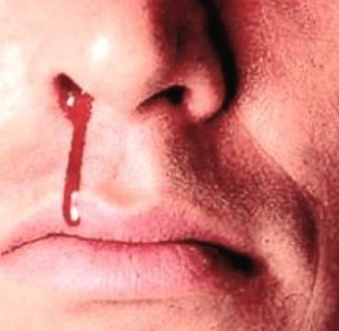 Epistaxis Natural Remedi - fasting