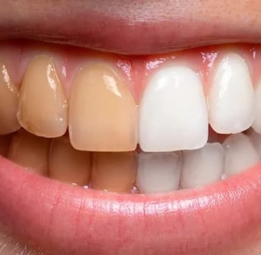 blanqueamiento dental