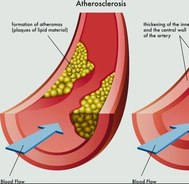 Arteriosclerosis
