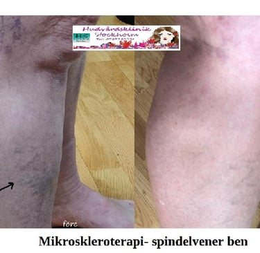 Ben med två ådernätskluster före skleroterapi och 6 veckor efter behandling