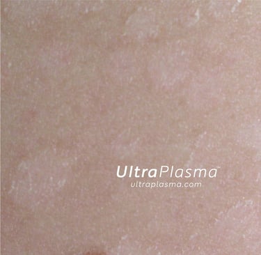 ultraplasma.com_Tinea_Versicolor_treatment_tinea_mantar_tedavi_ultrap_plasma_ultra_plazma