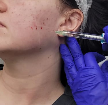 KINVIVE by Juvederm treatment at Ariana Esthetic Edmonton