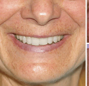 Women with Weneers before and after