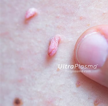 ultraplasma.com_skin_tag_removal_treatment_et_beni_temizleme_silme_tedavi_ultra_plasma_ultra_plazma2