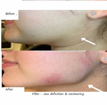 Före- & efterbild filler käklinje – tydligare ansiktskontur, smalare profil och väl markerad käke.
