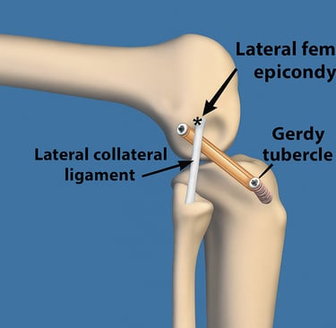 Lateral Extra-Articular Tendoesis (lET)
