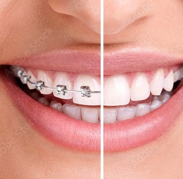 a woman with braces and braces on her teeth