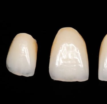 corona dental ceramica
