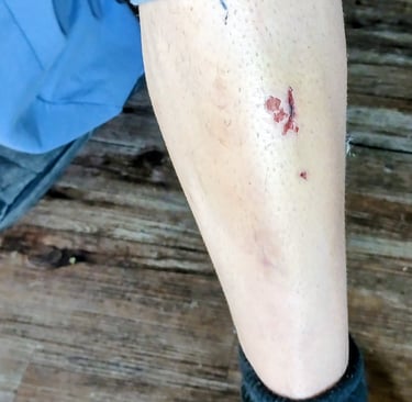 cut on shin fro pedal slip