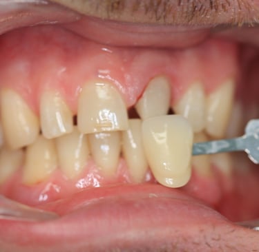 Sostituzione Incisivo Centrale, caso clinico