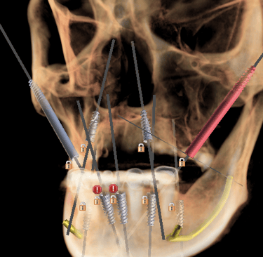 zygoma implant planning, all on 4 , all on 6 implants