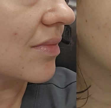 KINVIVE by Juvederm treatment at Ariana Esthetic Edmonton