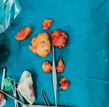 Lipoma: Types, Inheritance, Treatment & Cancer Conversion