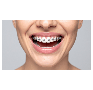 ortodoncia con brackets en gran canaria