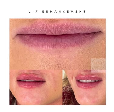Lip filler at MA SALONS