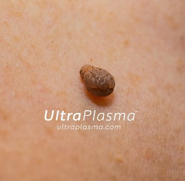 ultraplasma.com_skin_tag_removal_treatment_et_beni_temizleme_silme_tedavi_ultra_plasma_ultra_plazma