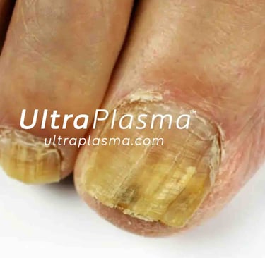nail_fungus_onychomycosis_ultra_plasma_ultra_plazma_ultra-plasma_ultra-plazma