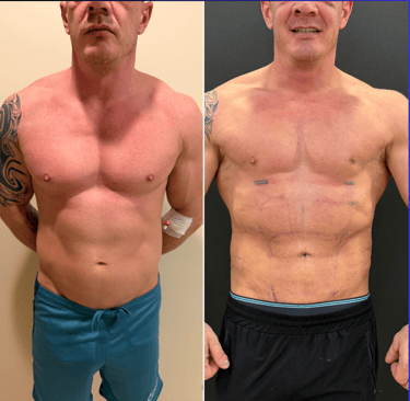 Before and after photos showing defined abdominal etching results on a patient.