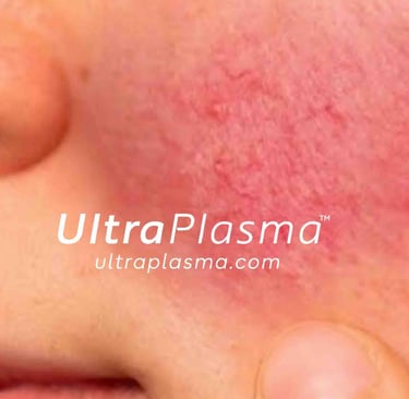 rosacea_roza_hastaligi_tedavi_treatment_ultra_plasma_ultra_plazma_ultra-plasma_ultra-plazma