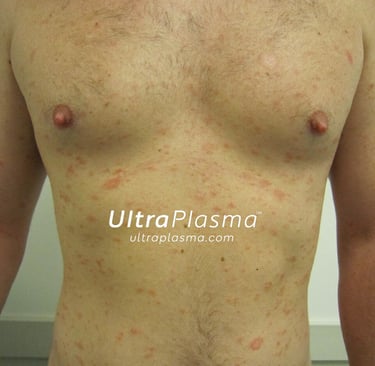 ultraplasma.com_Pityriasis_Rosea_treatment_ultra_plasma_ultra_plazma_1