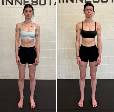 woman with scoliosis demonstrating improved posture and decreased pain in before vs after pictures