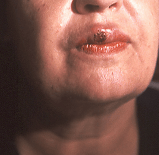 პირველადი სიფილისი - ორალური შანკრი - samedicino-targmani.ge