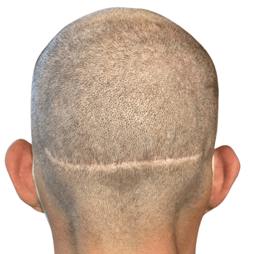 un homme aillant une cicatrice due à une greffe de cheveux
