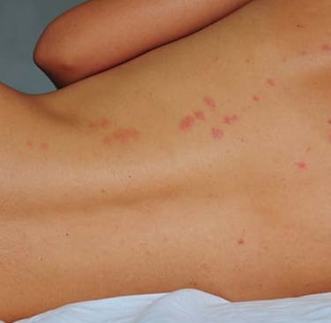 Mntreal Bed Bug Bites