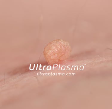 ultraplasma.com_skin_tag_removal_treatment_et_beni_temizleme_silme_tedavi_ultra_plasma_ultra_plazma2