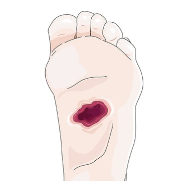 Illustration of a diabetic foot sore