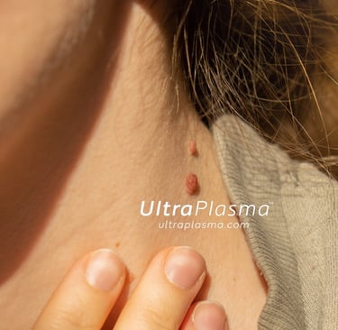 ultraplasma.com_skin_tag_removal_treatment_et_beni_temizleme_silme_tedavi_ultra_plasma_ultra_plazma