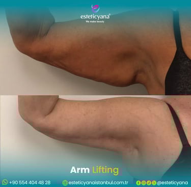 Arm lift before and after