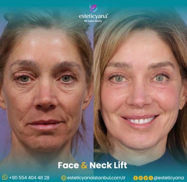 Face and neck lift before and after