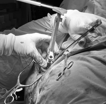 Preparación de canal medular de húmero en prótesis reversa de hombro