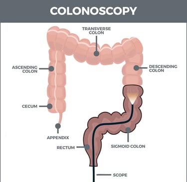 Colonoscopia demonstrando as partes anatômicas do intestino durante o exame.