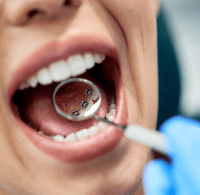 Lingual Braces Sydney