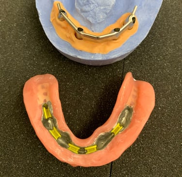 sobredentadura sobre barra fresada