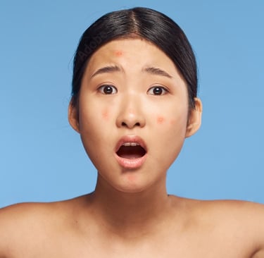 Acne treatment, skin treatment, medication acne, tretinoin, prescription 