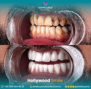 Hollywood smile before and after