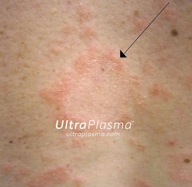 ultraplasma.com_Pityriasis_Rosea_treatment_ultra_plasma_ultra_plazma
