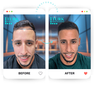 قبل وبعد زراعة الشعر