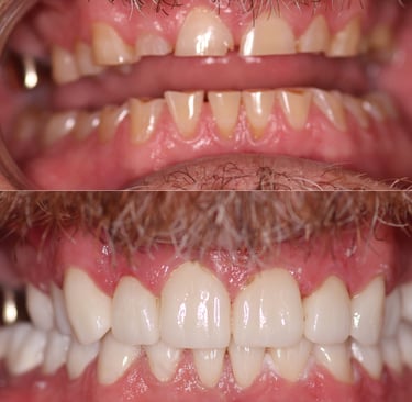 Before and after full mouth rehabilitation 