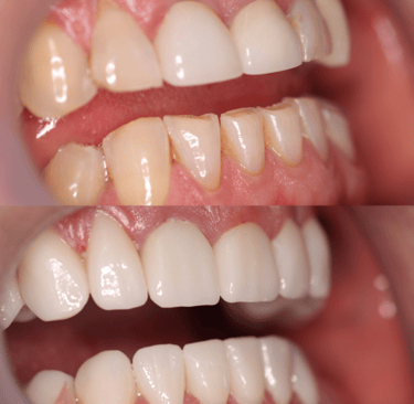 Side view of a before and after full zirconium crowns