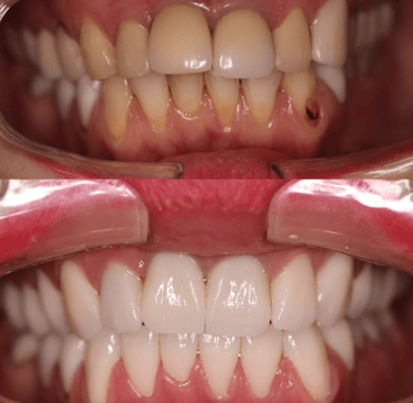 front view of before and after full zirconium crowns