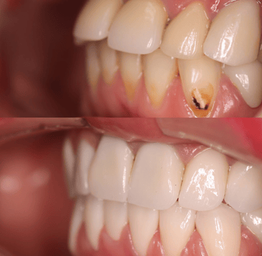 front view of before and after full zirconium crowns