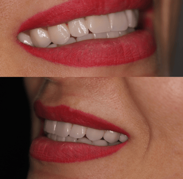 side view of before and after full zirconium crowns