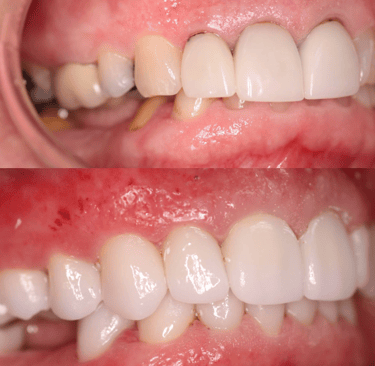 Full Mouth Rehabilitation