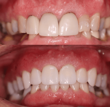 Full Mouth Rehabilitation